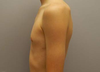 Photo of the chest wall after the Abramson Procedure