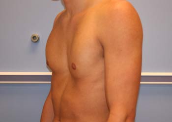Photo of the chest wall caved in.