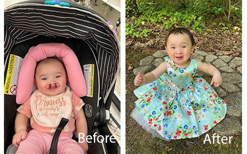 Alita Caolie before and After cleft surgery