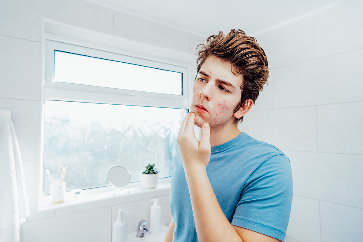 Teenage boy with acne looking in the mirror. 