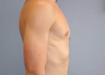 Photo of a chest after compression bracing.