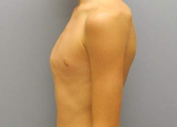 Photo of a protruding chest wall.