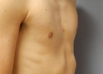 Photo of a chest after vacuum bell treatment