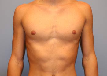 Photo of a Chest after the Nuss Procedure