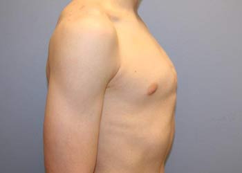 Photo of protruding chest wall before compression bracing.
